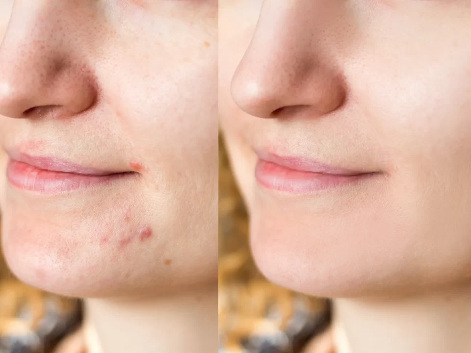 Best Acne Scar Removal Cream In India